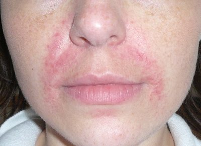 Rosacea schüssler salze Wie Sie