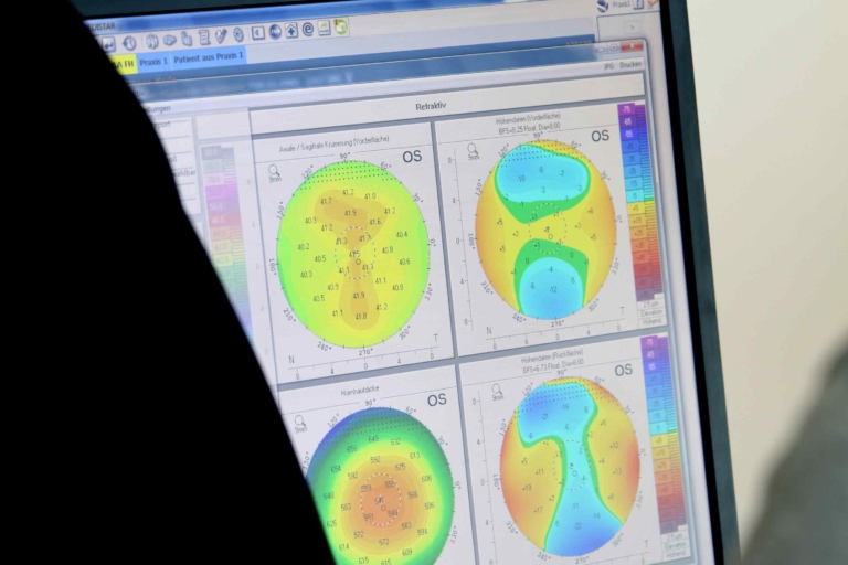 [Teil 1] Augen lasern mit der SMILE Methode Beratung