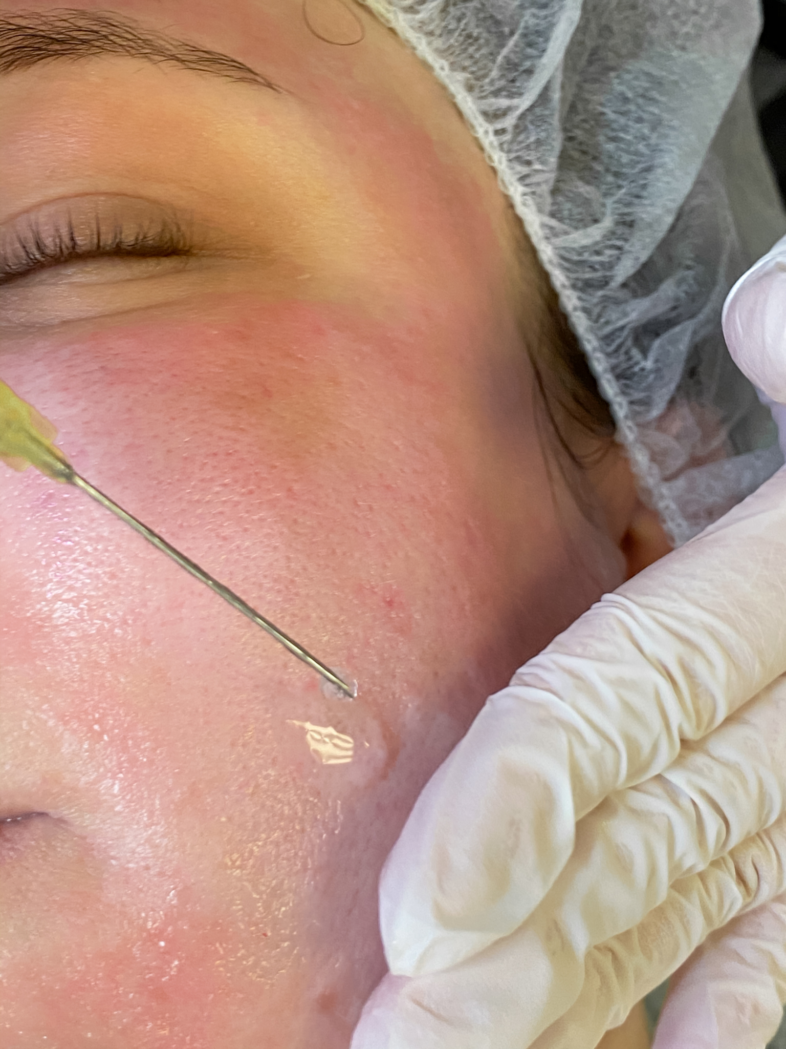 Radiofrequenz Microneedling Ksae Beauty Mein Erfahrungsbericht Innenaussen