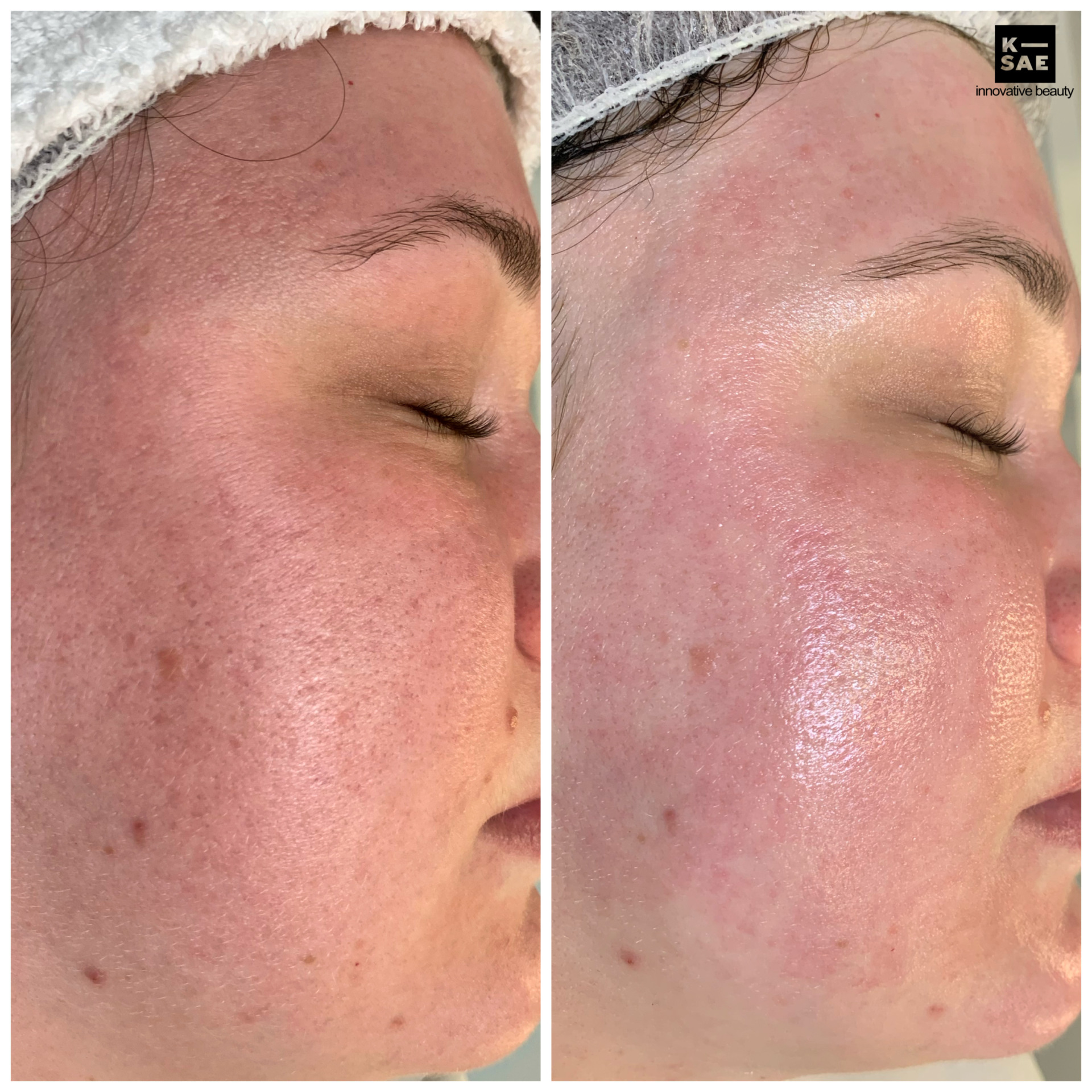 RadiofrequenzMicroneedling KSAE Beauty Mein Erfahrungsbericht InnenAussen